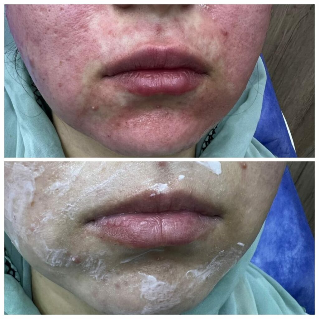 Lip filler injections